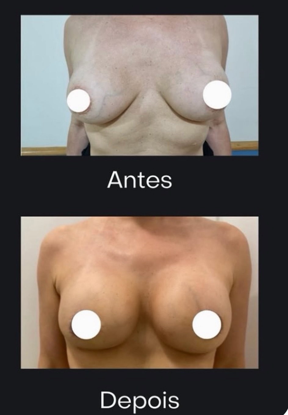 Próteses de mama