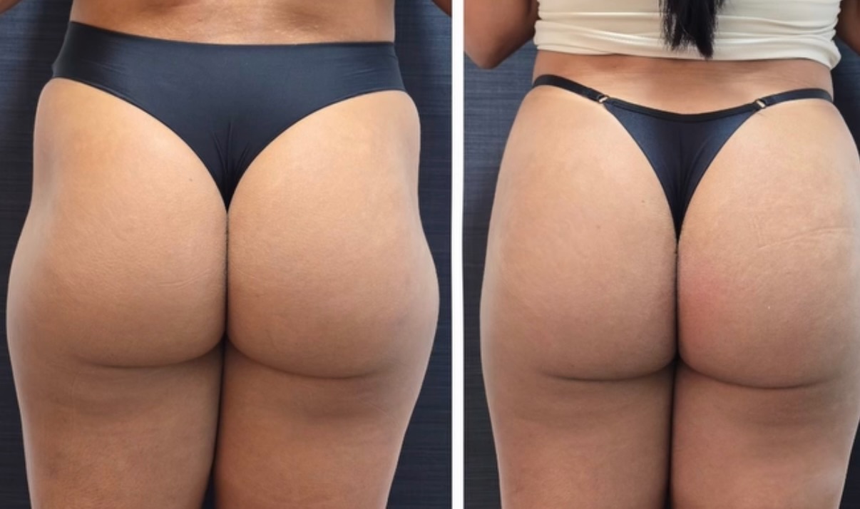 Modelação de glúteos — vista posterior